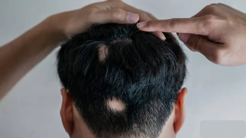 Alopecia Areata